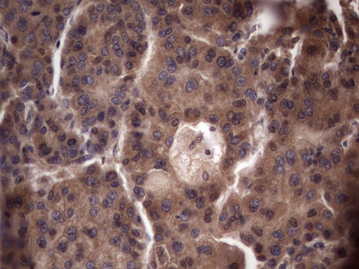 UFD1L Antibody - Immunohistochemical staining of paraffin-embedded Carcinoma of Human liver tissue using anti-UFD1L mouse monoclonal antibody. (Heat-induced epitope retrieval by 1 mM EDTA in 10mM Tris, pH8.5, 120C for 3min,