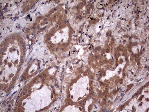 UFD1L Antibody - Immunohistochemical staining of paraffin-embedded Carcinoma of Human lung tissue using anti-UFD1L mouse monoclonal antibody. (Heat-induced epitope retrieval by 1 mM EDTA in 10mM Tris, pH8.5, 120C for 3min,