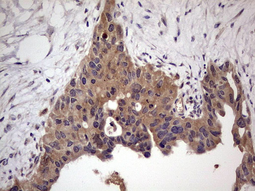 UFD1L Antibody - Immunohistochemical staining of paraffin-embedded Carcinoma of Human pancreas tissue using anti-UFD1L mouse monoclonal antibody. (Heat-induced epitope retrieval by 1 mM EDTA in 10mM Tris, pH8.5, 120C for 3min,