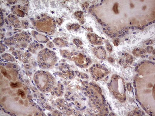 UFD1L Antibody - Immunohistochemical staining of paraffin-embedded Carcinoma of Human thyroid tissue using anti-UFD1L mouse monoclonal antibody. (Heat-induced epitope retrieval by 1 mM EDTA in 10mM Tris, pH8.5, 120C for 3min,