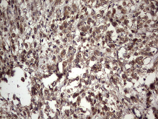 UFD1L Antibody - Immunohistochemical staining of paraffin-embedded Adenocarcinoma of Human breast tissue using anti-UFD1L mouse monoclonal antibody. (Heat-induced epitope retrieval by 1 mM EDTA in 10mM Tris, pH8.5, 120C for 3min,