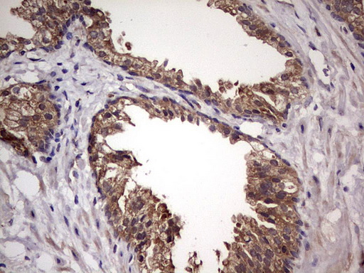 UFD1L Antibody - Immunohistochemical staining of paraffin-embedded Carcinoma of Human prostate tissue using anti-UFD1L mouse monoclonal antibody. (Heat-induced epitope retrieval by 1 mM EDTA in 10mM Tris, pH8.5, 120C for 3min,