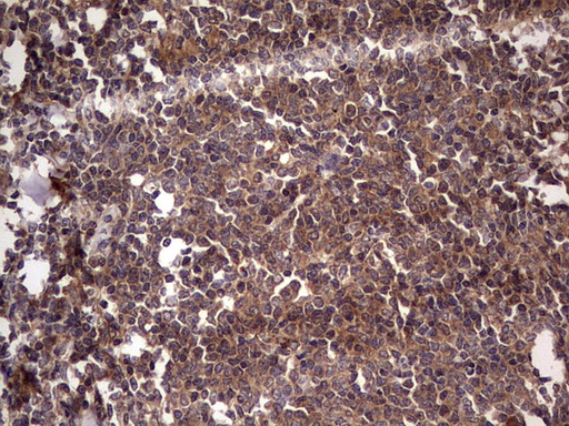 UFD1L Antibody - Immunohistochemical staining of paraffin-embedded Human lymphoma tissue using anti-UFD1L mouse monoclonal antibody. (Heat-induced epitope retrieval by 1 mM EDTA in 10mM Tris, pH8.5, 120C for 3min,