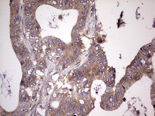 UFD1L Antibody - Immunohistochemical staining of paraffin-embedded Adenocarcinoma of Human colon tissue using anti-UFD1L mouse monoclonal antibody. (Heat-induced epitope retrieval by 1 mM EDTA in 10mM Tris, pH8.5, 120C for 3min,