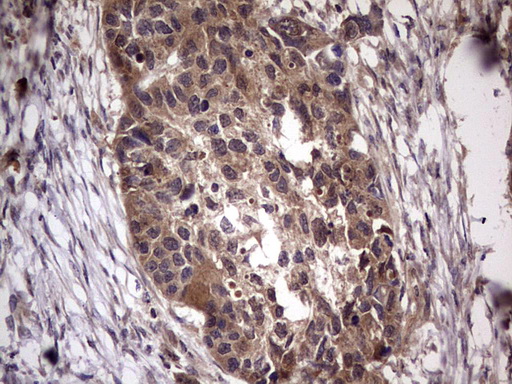 UFD1L Antibody - Immunohistochemical staining of paraffin-embedded Carcinoma of Human kidney tissue using anti-UFD1L mouse monoclonal antibody. (Heat-induced epitope retrieval by 1 mM EDTA in 10mM Tris, pH8.5, 120C for 3min,