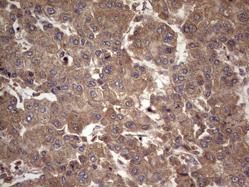 UFD1L Antibody - IHC of paraffin-embedded Carcinoma of Human liver tissue using anti-UFD1L mouse monoclonal antibody. (Heat-induced epitope retrieval by 1 mM EDTA in 10mM Tris, pH8.5, 120°C for 3min).