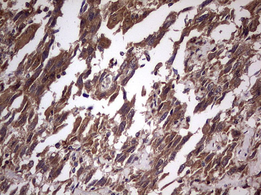 UFD1L Antibody - IHC of paraffin-embedded Adenocarcinoma of Human ovary tissue using anti-UFD1L mouse monoclonal antibody. (Heat-induced epitope retrieval by 1 mM EDTA in 10mM Tris, pH8.5, 120°C for 3min).