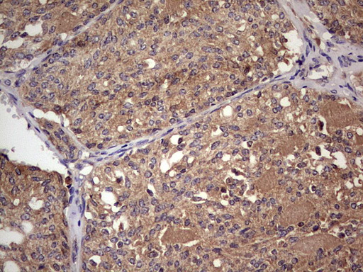 UFD1L Antibody - IHC of paraffin-embedded Human thyroid tissue using anti-UFD1L mouse monoclonal antibody. (Heat-induced epitope retrieval by 1 mM EDTA in 10mM Tris, pH8.5, 120°C for 3min).
