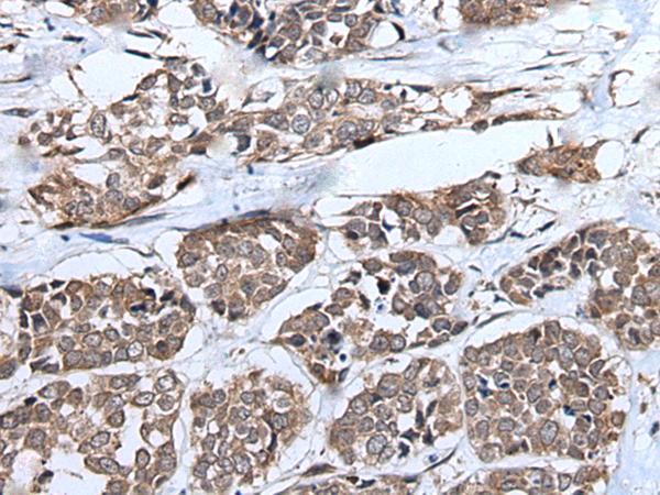 UFD2A / UBE4B Antibody - Immunohistochemistry of paraffin-embedded Human esophagus cancer tissue  using UBE4B Polyclonal Antibody at dilution of 1:40(×200)