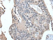UFM1 Antibody - Immunohistochemistry of paraffin-embedded Human colorectal cancer tissue  using UFM1 Polyclonal Antibody at dilution of 1:45(×200)