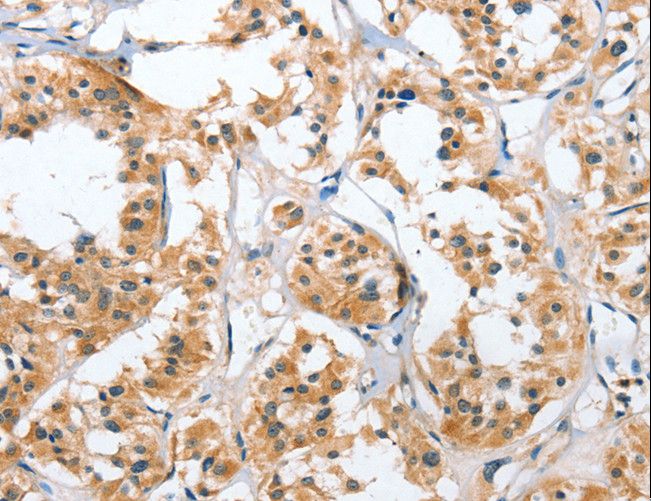 UGCG Antibody - Immunohistochemistry of paraffin-embedded Human thyroid cancer using UGCG Polyclonal Antibody at dilution of 1:50.