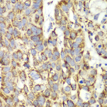 UGDH / UDPGDH Antibody - Immunohistochemistry of paraffin-embedded human lung cancer tissue.
