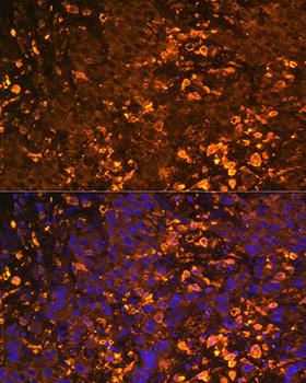 UGT1A / UGT1A1 Antibody - Immunofluorescence analysis of Human liver cancer using UGT1A1 Polyclonal Antibody at dilution of 1:100.Blue: DAPI for nuclear staining.