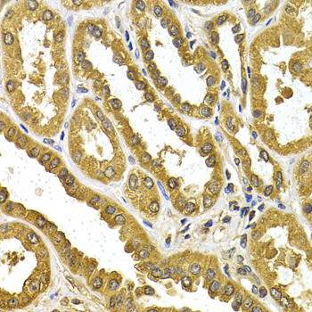 UGT1A4 Antibody - Immunohistochemistry of paraffin-embedded human kidney cancer tissue.