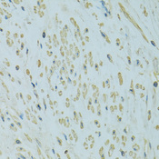 UGT1A6 Antibody - Immunohistochemistry of paraffin-embedded human uterine cancer using UGT1A6 antibodyat dilution of 1:100 (40x lens).