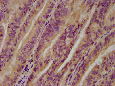 UGT1A6 Antibody - Immunohistochemistry image at a dilution of 1:200 and staining in paraffin-embedded human endometrial cancer performed on a Leica BondTM system. After dewaxing and hydration, antigen retrieval was mediated by high pressure in a citrate buffer (pH 6.0) . Section was blocked with 10% normal goat serum 30min at RT. Then primary antibody (1% BSA) was incubated at 4 °C overnight. The primary is detected by a biotinylated secondary antibody and visualized using an HRP conjugated SP system.