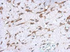 UGT1A9 Antibody - IHC of paraffin-embedded Hepatoma using UGT1A9 antibody at 1:500 dilution.