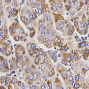 UGT1A9 Antibody - Immunohistochemistry of paraffin-embedded human liver cancer using UGT1A9 antibodyat dilution of 1:200 (40x lens).
