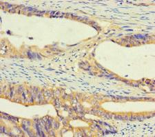 UGT2A3 Antibody - Immunohistochemistry of paraffin-embedded human colon cancer using UGT2A3 Antibody at dilution of 1:100
