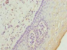 UGT2B10 Antibody - Immunohistochemistry of paraffin-embedded human cervical cancer at dilution 1:100