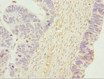 UGT2B10 Antibody - Immunohistochemistry of paraffin-embedded human ovarian cancer at dilution 1:100