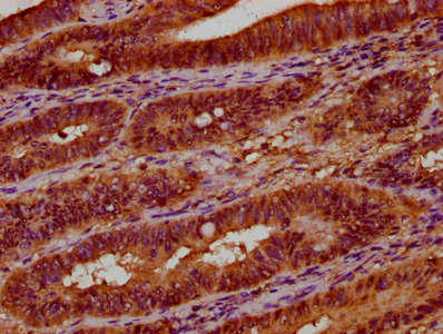UGT2B7 Antibody - Immunohistochemistry Dilution at 1:300 and staining in paraffin-embedded human colon cancer performed on a Leica BondTM system. After dewaxing and hydration, antigen retrieval was mediated by high pressure in a citrate buffer (pH 6.0). Section was blocked with 10% normal Goat serum 30min at RT. Then primary antibody (1% BSA) was incubated at 4°C overnight. The primary is detected by a biotinylated Secondary antibody and visualized using an HRP conjugated SP system.