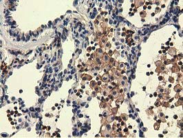 UHMK1 / KIS Antibody - Immunohistochemical staining of paraffin-embedded Carcinoma of Human lung tissue using anti-UHMK1 mouse monoclonal antibody.