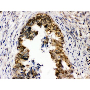 UHRF1 Antibody - UHRF1 was detected in paraffin-embedded sections of human intestinal cancer tissues using rabbit anti- UHRF1 Antigen Affinity purified polyclonal antibody at 1 ug/mL. The immunohistochemical section was developed using SABC method.