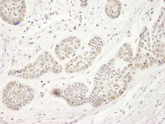 UHRF1 Antibody - Detection of Human NP95/UHRF1 by Immunohistochemistry. Sample: FFPE section of human basal cell carcinoma. Antibody: Affinity purified rabbit anti-NP95/UHRF1 used at a dilution of 1:250.