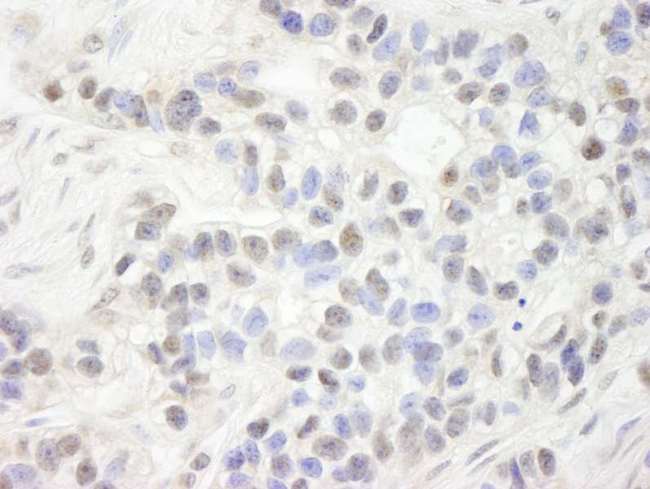 UHRF1 Antibody - Detection of Human NP95/UHRF1 by Immunohistochemistry. Sample: FFPE section of human breast carcinoma. Antibody: Affinity purified rabbit anti-NP95/UHRF1 used at a dilution of 1:250.