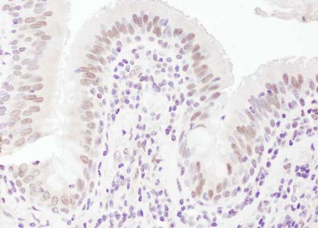 UHRF1 Antibody - Detection of Human NP95/UHRF1 by Immunohistochemistry. Sample: FFPE section of human lung carcinoma. Antibody: Affinity purified rabbit anti-NP95/UHRF1 used at a dilution of 1:200 (1 ug/ml). Detection: DAB.