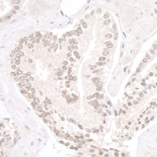UHRF1 Antibody - Detection of human NP95/UHRF1 by immunohistochemistry. Sample: FFPE section of human lung carcinoma. Antibody: Affinity purified rabbit anti- NP95/UHRF1 used at a dilution of 1:200 (1µg/ml). Detection: DAB