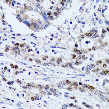 UHRF1 Antibody - Immunohistochemistry of paraffin-embedded human colon carcinoma tissue.