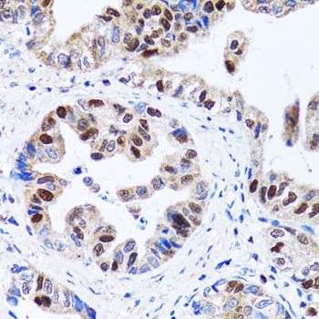 UHRF1 Antibody - Immunohistochemistry of paraffin-embedded human gastric cancer tissue.