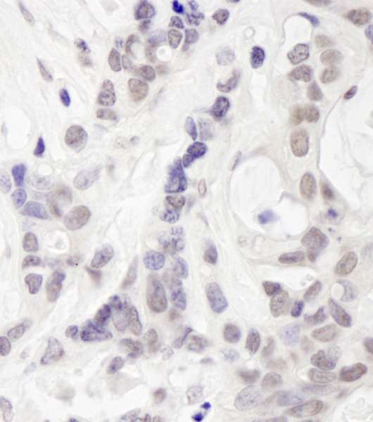 UIMC1 / RAP80 Antibody - Detection of Human RAP80 by Immunohistochemistry. Sample: FFPE section of human ovarian carcinoma. Antibody: Affinity purified rabbit anti-RAP80 used at a dilution of 1:250. Epitope Retrieval Buffer-High pH (IHC-101J) was substituted for Epitope Retrieval Buffer-Reduced pH.