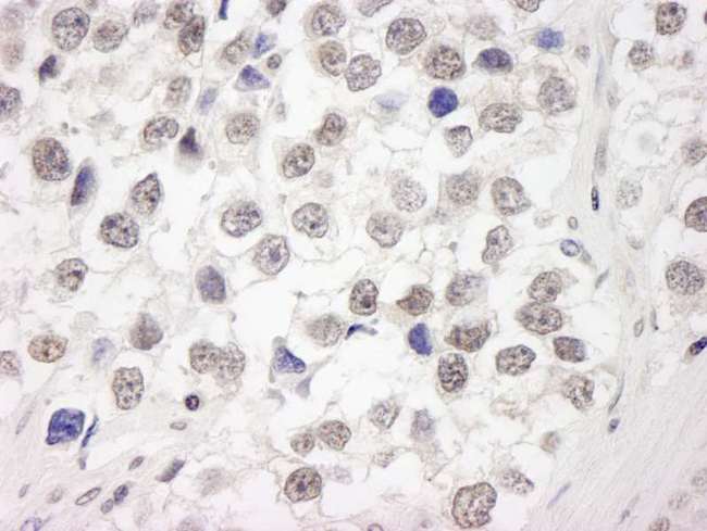 UIMC1 / RAP80 Antibody - Detection of Human RAP80 by Immunohistochemistry. Sample: FFPE section of human seminoma. Antibody: Affinity purified rabbit anti-RAP80 used at a dilution of 1:250. Epitope Retrieval Buffer-High pH (IHC-101J) was substituted for Epitope Retrieval Buffer-Reduced pH.