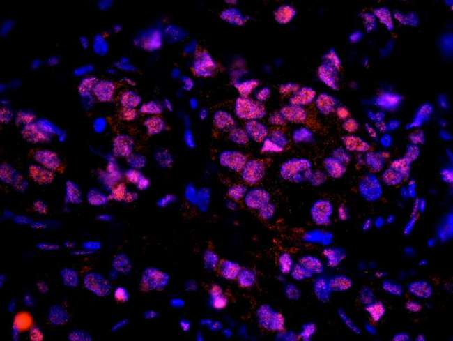 UIMC1 / RAP80 Antibody - Detection of Human RAP80 by Immunohistochemistry. Sample: FFPE section of human breast carcinoma. Antibody: Affinity purified rabbit anti-RAP80 used at a dilution of 1:100. Detection: Red-fluorescent goat anti-rabbit IgG highly cross-adsorbed Antibody used at a dilution of 1:100.