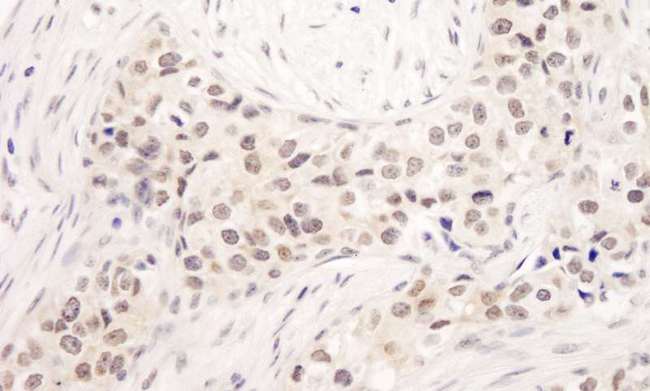 UIMC1 / RAP80 Antibody - Detection of Human RAP80 by Immunohistochemistry. Sample: FFPE section of human breast carcinoma. Antibody: Affinity purified rabbit anti-RAP80 used at a dilution of 1:1000 (1 ug/ml). Detection: DAB.