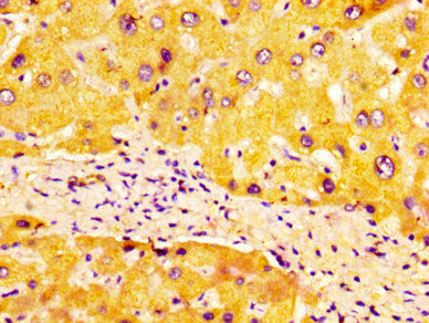 ULBP1 Antibody - Immunohistochemistry image at a dilution of 1:100 and staining in paraffin-embedded human liver tissue performed on a Leica BondTM system. After dewaxing and hydration, antigen retrieval was mediated by high pressure in a citrate buffer (pH 6.0) . Section was blocked with 10% normal goat serum 30min at RT. Then primary antibody (1% BSA) was incubated at 4 °C overnight. The primary is detected by a biotinylated secondary antibody and visualized using an HRP conjugated SP system.