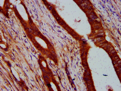 ULK2 Antibody - Immunohistochemistry Dilution at 1:400 and staining in paraffin-embedded human colon cancer performed on a Leica BondTM system. After dewaxing and hydration, antigen retrieval was mediated by high pressure in a citrate buffer (pH 6.0). Section was blocked with 10% normal Goat serum 30min at RT. Then primary antibody (1% BSA) was incubated at 4°C overnight. The primary is detected by a biotinylated Secondary antibody and visualized using an HRP conjugated SP system.