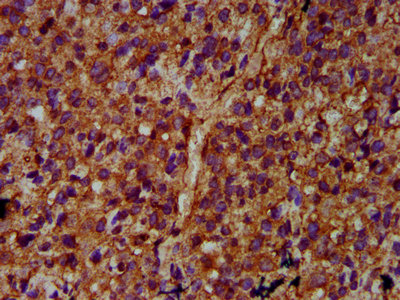 ULK2 Antibody - Immunohistochemistry Dilution at 1:400 and staining in paraffin-embedded human glioma cancer performed on a Leica BondTM system. After dewaxing and hydration, antigen retrieval was mediated by high pressure in a citrate buffer (pH 6.0). Section was blocked with 10% normal Goat serum 30min at RT. Then primary antibody (1% BSA) was incubated at 4°C overnight. The primary is detected by a biotinylated Secondary antibody and visualized using an HRP conjugated SP system.
