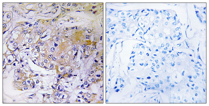 ULK3 Antibody - Immunohistochemistry analysis of paraffin-embedded human breast carcinoma tissue, using ULK3 Antibody. The picture on the right is blocked with the synthesized peptide.