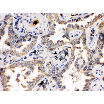 ULK3 Antibody - ULK3 antibody IHC-paraffin. IHC(P): Human Lung Cancer Tissue.