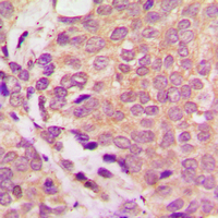 ULK3 Antibody - Immunohistochemical analysis of ULK3 staining in human prostate cancer formalin fixed paraffin embedded tissue section. The section was pre-treated using heat mediated antigen retrieval with sodium citrate buffer (pH 6.0). The section was then incubated with the antibody at room temperature and detected using an HRP conjugated compact polymer system. DAB was used as the chromogen. The section was then counterstained with hematoxylin and mounted with DPX.