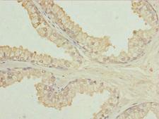 ULK3 Antibody - Immunohistochemistry of paraffin-embedded human prostate cancer at dilution 1:100