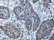 ULK4 Antibody - Immunohistochemistry of paraffin-embedded Human cervical cancer tissue  using ULK4 Polyclonal Antibody at dilution of 1:75(×200)