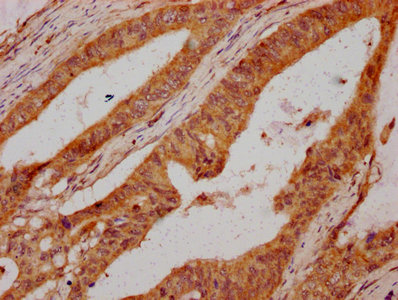 UMODL1 Antibody - Immunohistochemistry Dilution at 1:300 and staining in paraffin-embedded human colon cancer performed on a Leica BondTM system. After dewaxing and hydration, antigen retrieval was mediated by high pressure in a citrate buffer (pH 6.0). Section was blocked with 10% normal Goat serum 30min at RT. Then primary antibody (1% BSA) was incubated at 4°C overnight. The primary is detected by a biotinylated Secondary antibody and visualized using an HRP conjugated SP system.