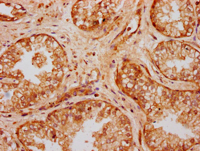 UMODL1 Antibody - Immunohistochemistry Dilution at 1:300 and staining in paraffin-embedded human prostate cancer performed on a Leica BondTM system. After dewaxing and hydration, antigen retrieval was mediated by high pressure in a citrate buffer (pH 6.0). Section was blocked with 10% normal Goat serum 30min at RT. Then primary antibody (1% BSA) was incubated at 4°C overnight. The primary is detected by a biotinylated Secondary antibody and visualized using an HRP conjugated SP system.