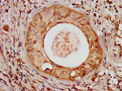 UMPS / OPRT Antibody - IHC image of UMPS Antibody diluted at 1:100 and staining in paraffin-embedded human cervical cancer performed on a Leica BondTM system. After dewaxing and hydration, antigen retrieval was mediated by high pressure in a citrate buffer (pH 6.0). Section was blocked with 10% normal goat serum 30min at RT. Then primary antibody (1% BSA) was incubated at 4°C overnight. The primary is detected by a biotinylated secondary antibody and visualized using an HRP conjugated SP system.