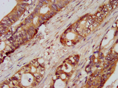 UMPS / OPRT Antibody - IHC image of UMPS Antibody diluted at 1:100 and staining in paraffin-embedded human colon cancer performed on a Leica BondTM system. After dewaxing and hydration, antigen retrieval was mediated by high pressure in a citrate buffer (pH 6.0). Section was blocked with 10% normal goat serum 30min at RT. Then primary antibody (1% BSA) was incubated at 4°C overnight. The primary is detected by a biotinylated secondary antibody and visualized using an HRP conjugated SP system.